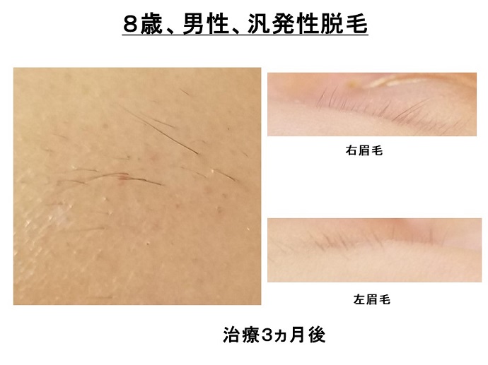 円形脱毛症　病院